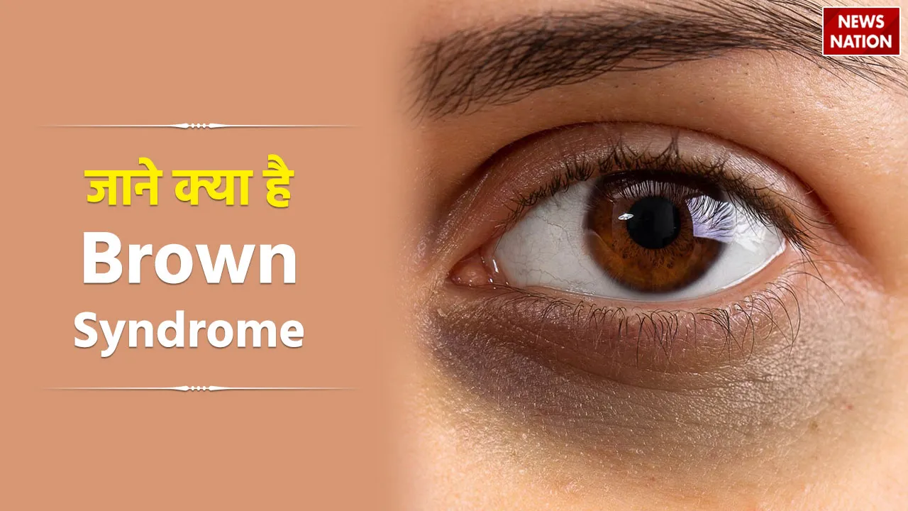 Brown Syndrome