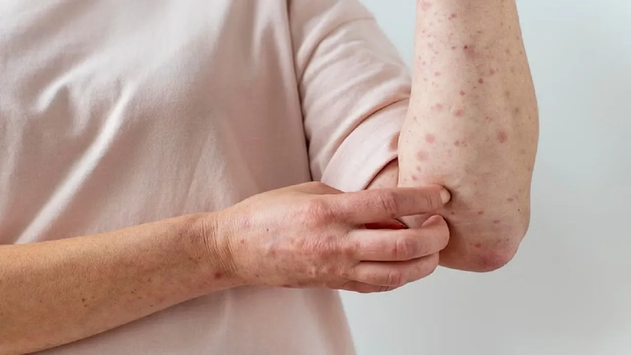Measles Disease