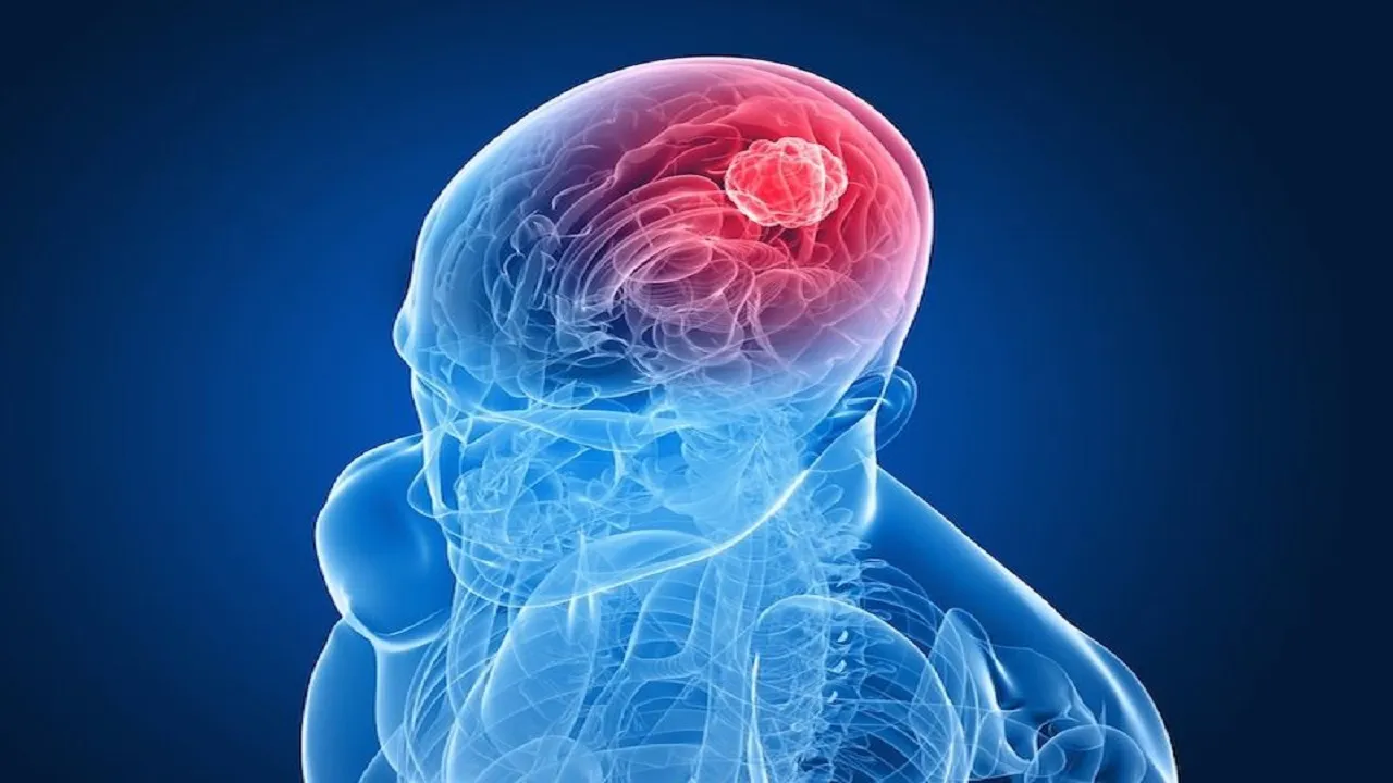 Brain tumours