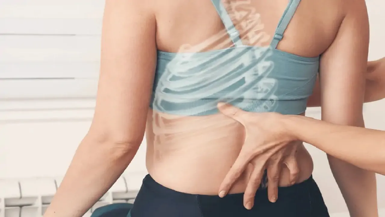 Lordosis
