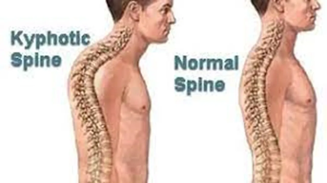 what is kyphosis know its symptoms causes and treatment