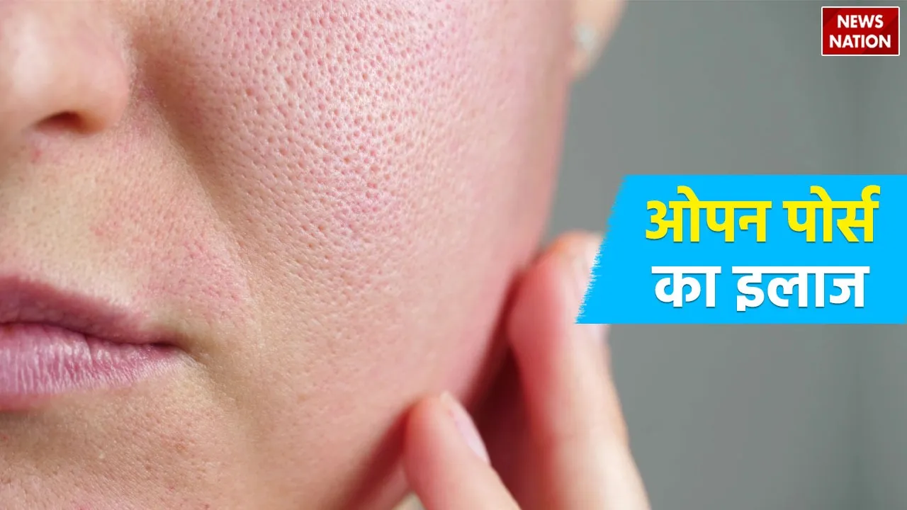 OPen Pores Treatment