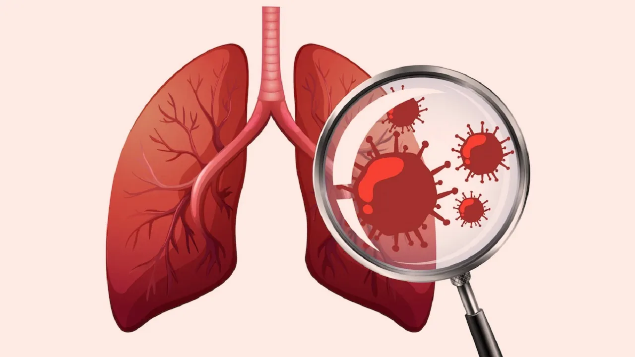 Respiratory Syncytial Virus