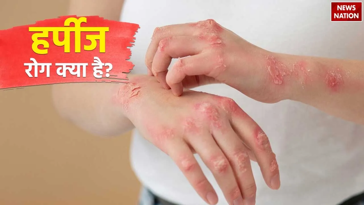 Herpes Disease