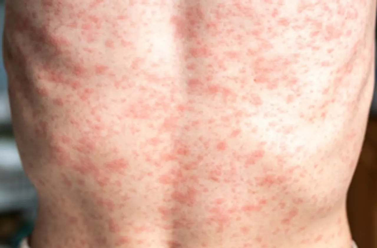 Over 900 measles cases reported in US so far in 2025: CDC
