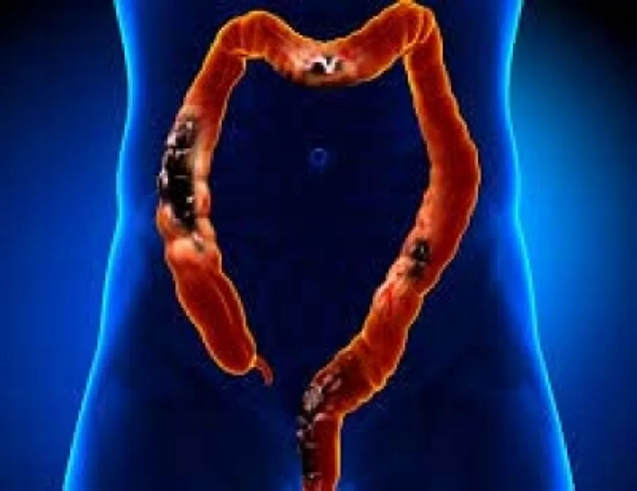 Gene-editing therapy shows promise against advanced colorectal cancer