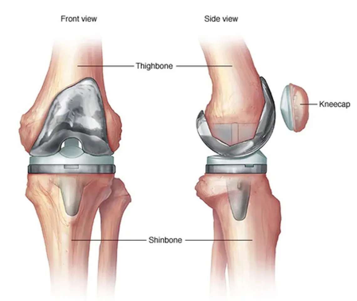 Diabetes may raise infection, blood clot risk post knee replacement surgery: Study