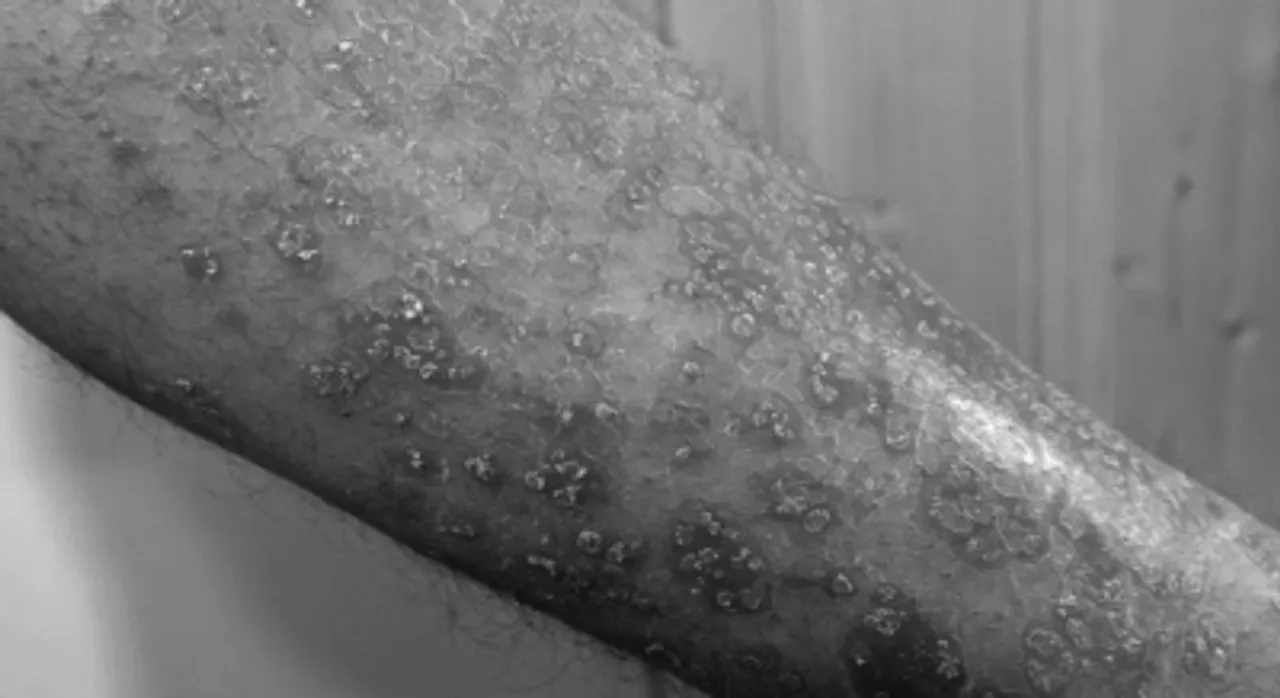 Free Photo, Psoriasis, deeper than you think