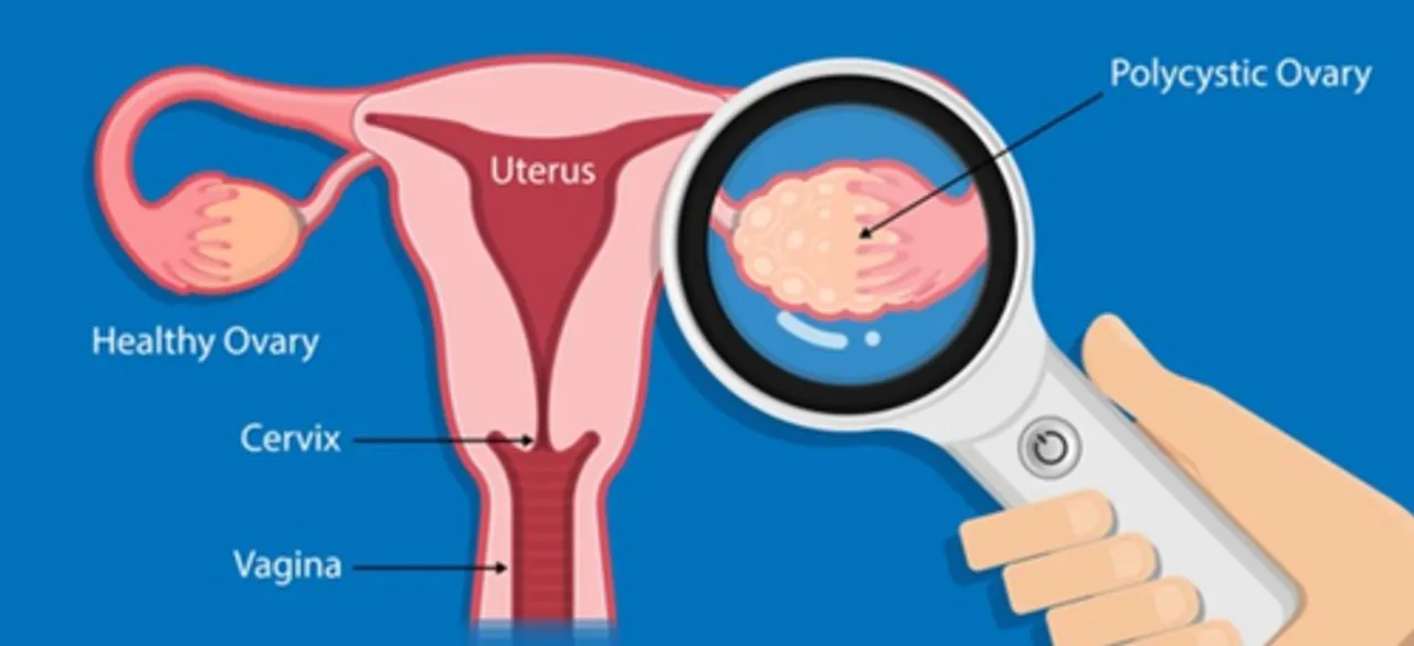PCOS may double risk of ovarian cancer after menopause: Study