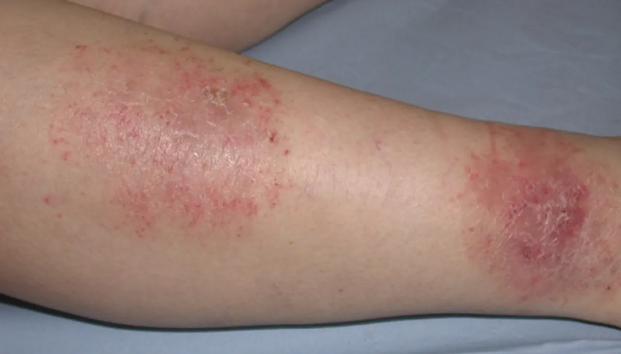 ଏକଜିମାର ଆୟୁର୍ବେଦିକ ଚିକିତ୍ସା