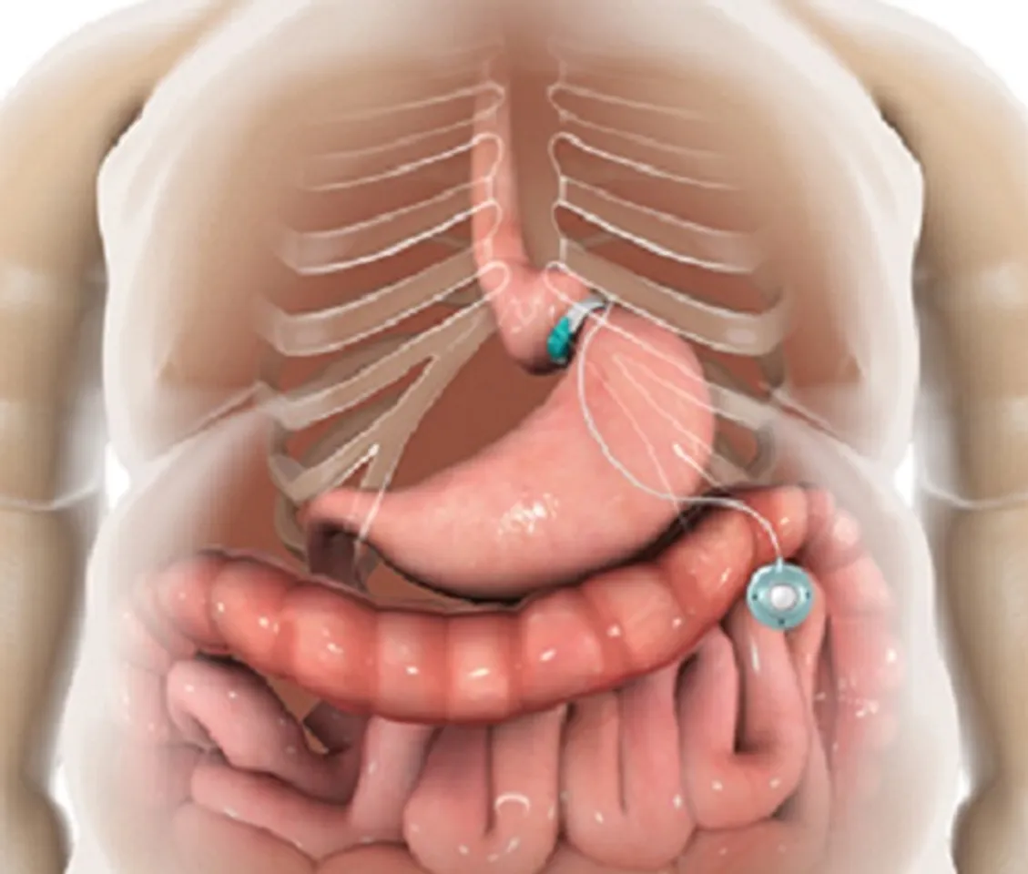 କେବଳ ଡାକ୍ତରୀ ଔଷଧ ନୁହେଁ ଘରୋଇ ଉପାୟରେ ବି ଦୂର ହୁଏ ଗ୍ୟାଷ୍ଟ୍ରିକ୍‌