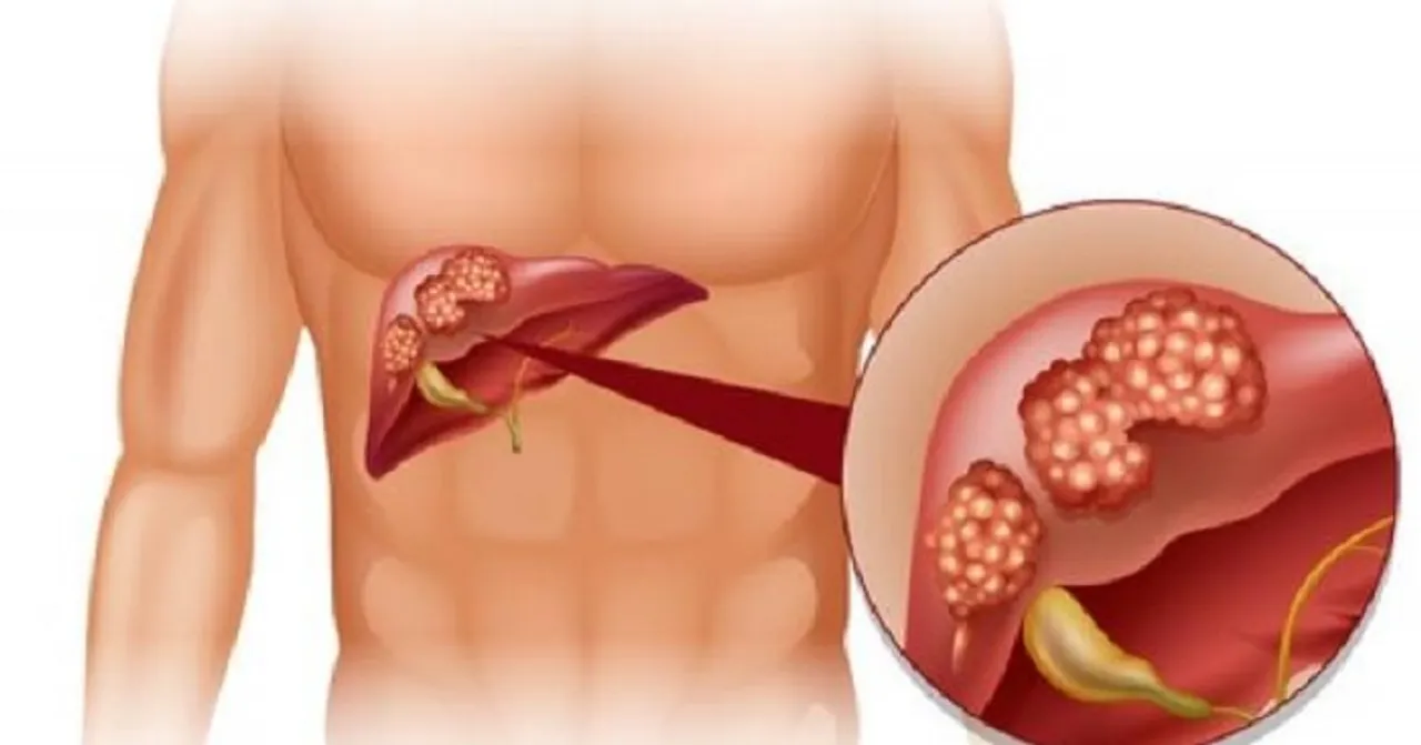 ସାବଧାନ! ଏହି ୫ ପ୍ରକାର ଲୋକଙ୍କୁ ହୋଇପାରେ ଲିଭର କ୍ୟାନସର