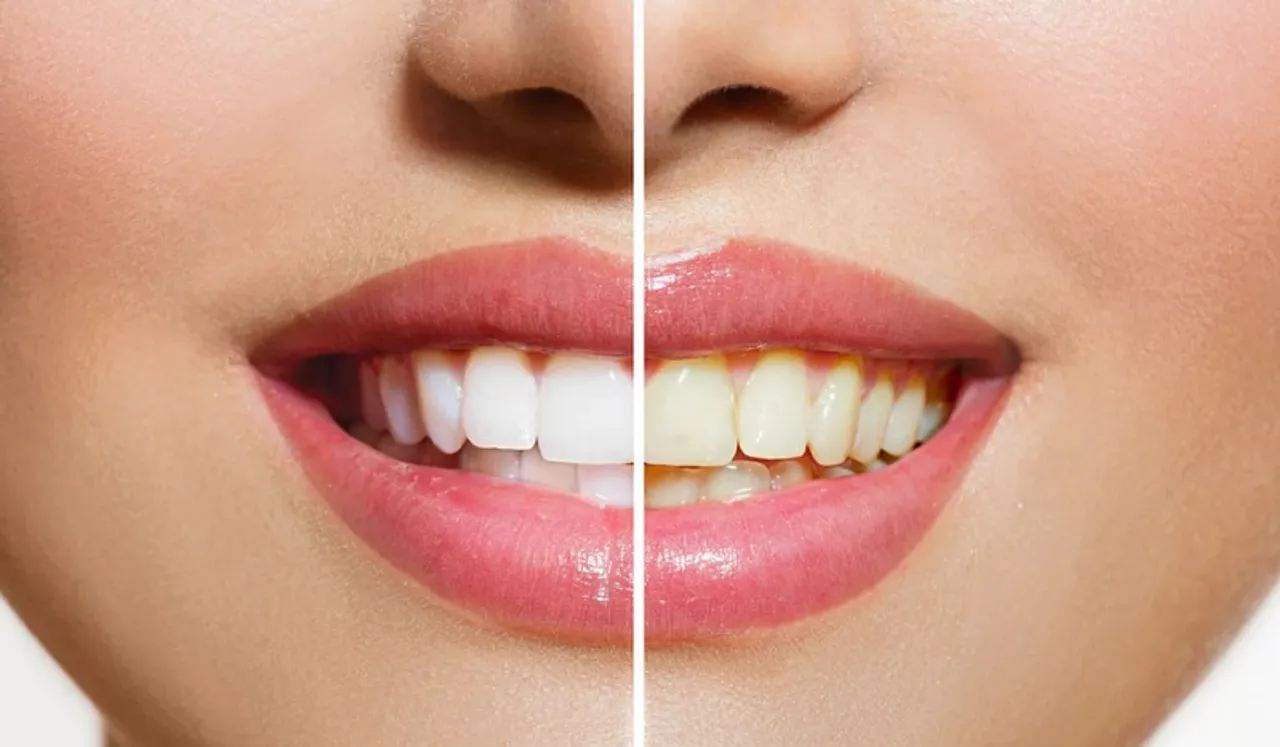 ଦାନ୍ତ ହଳଦିଆ ପଡ଼ି ଯାଉଛି କି? ପଢ଼ନ୍ତୁ କିଛି ଘରୋଇ ଉପଚାର