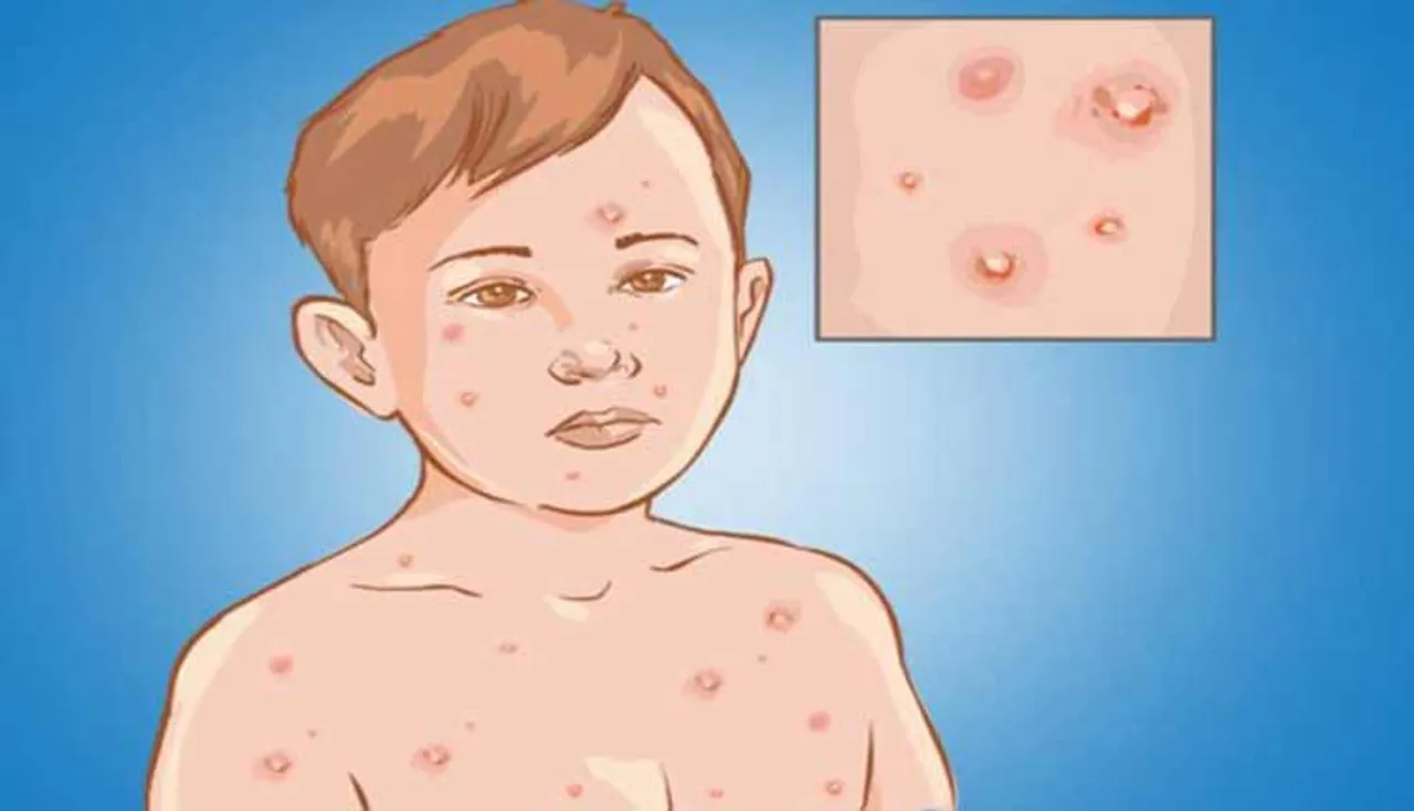 'ଚିକେନ୍‌ ପକ୍ସ' ଦାଗ ଦୂର ପାଇଁ ଆପଣାନ୍ତୁ ଏହି ସବୁ ଘରୋଇ ଉପଚାର