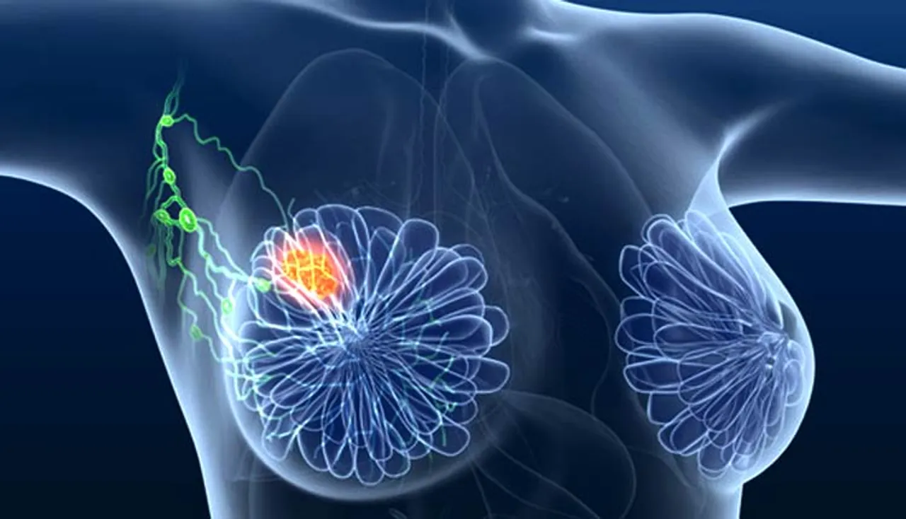 ସ୍ତନ କର୍କଟ: ଜାଣନ୍ତୁ ଲକ୍ଷଣ, ଦୂର କରନ୍ତୁ ଭୁଲ୍‌ ଧାରଣା