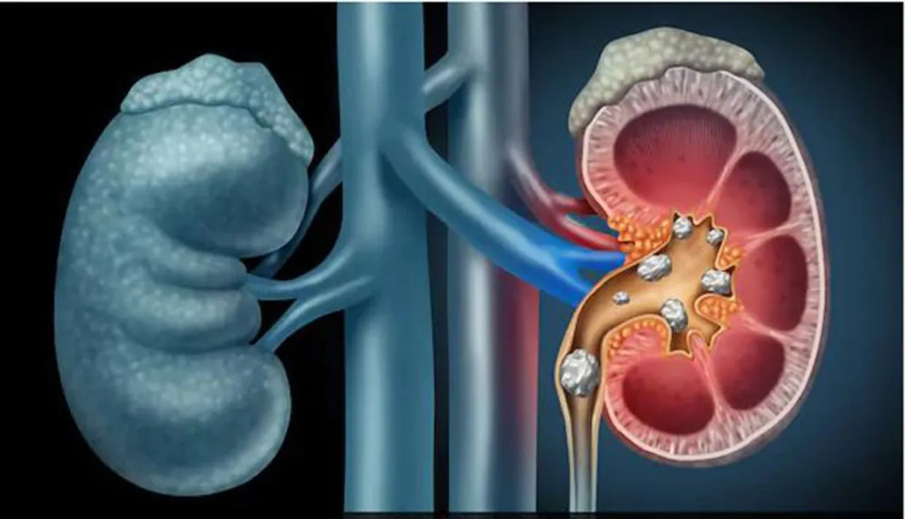 କିଡ୍‌ନୀ ଷ୍ଟୋନ୍‌ର ଘରୋଇ ଉପଚାର