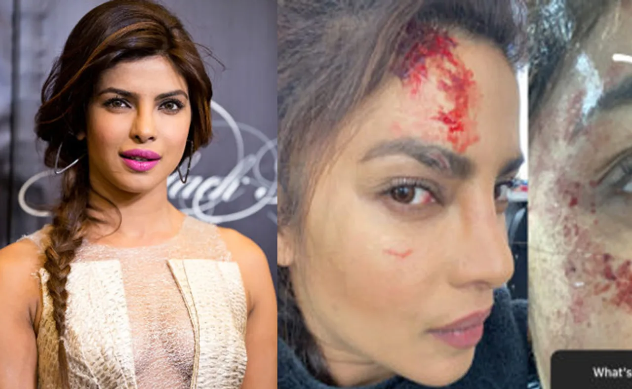 ପ୍ରିୟଙ୍କା ଚୋପ୍ରା ଆହତ, ଫାଟିଲା ମୁଣ୍ଡ