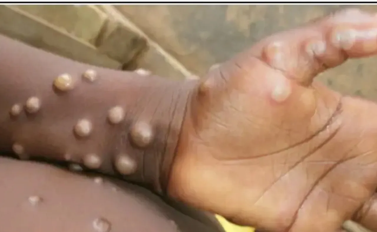 କ’ଣ ମଙ୍କିପକ୍ସ ମହାମାରୀ କରୋନା ଭଳି ସ୍ଥିତି ସୃଷ୍ଟି କରିବ? ଜବାବ ରଖିଲେ ବିଶେଷଜ୍ଞ