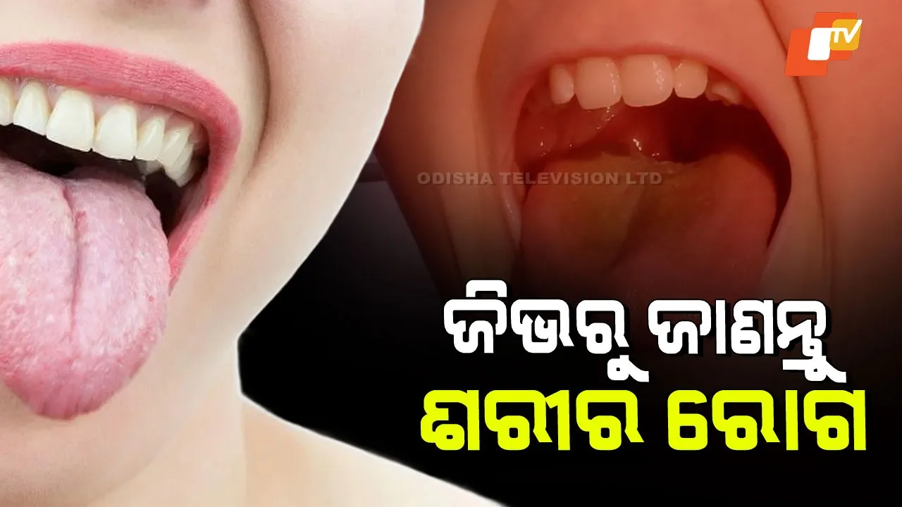 White or Yellow Tongue Coating