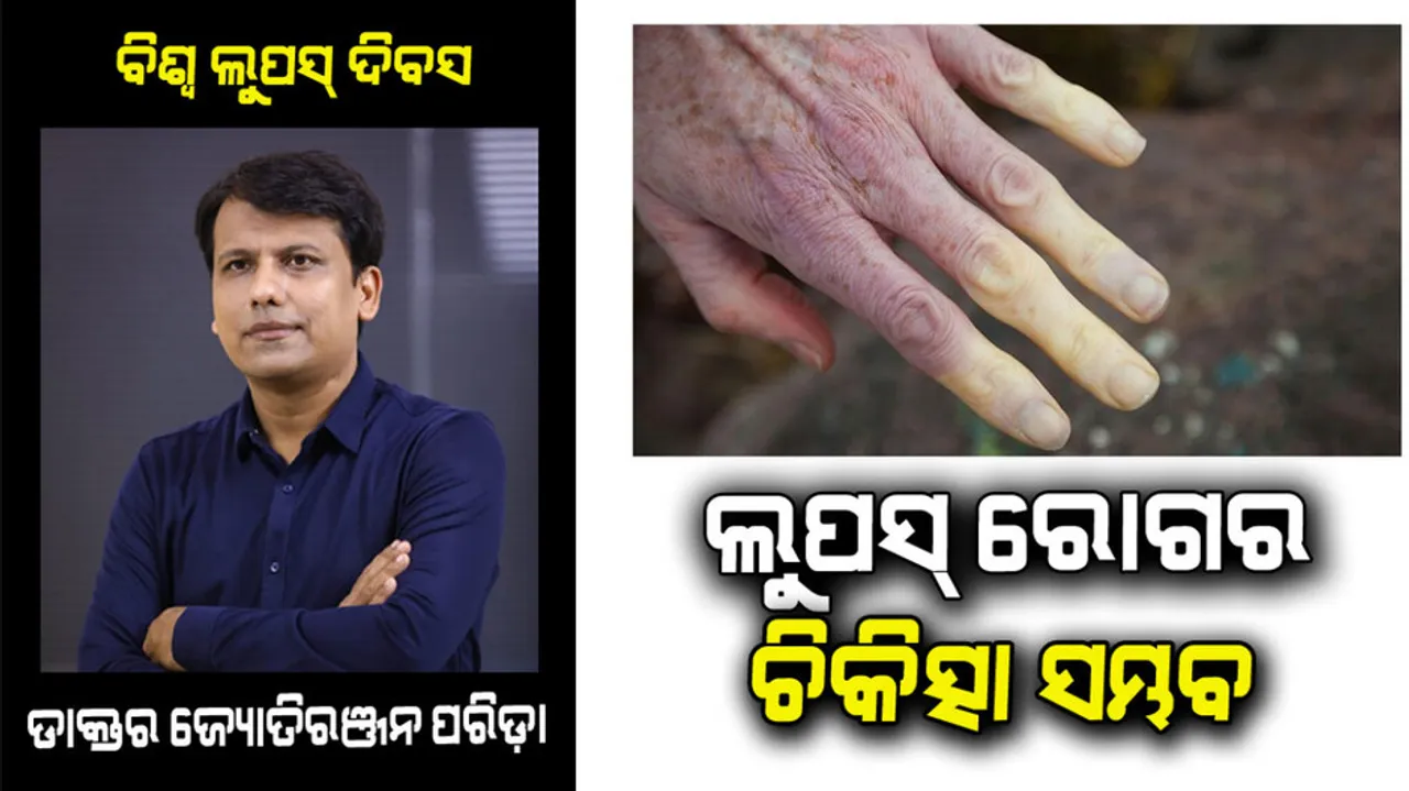 World Lupus Day 2022