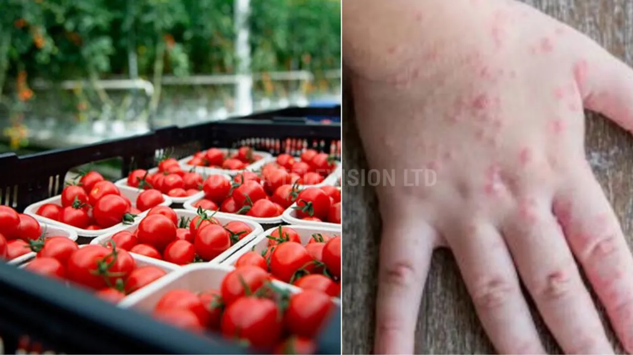 What is tomato flu? Who does it affect?