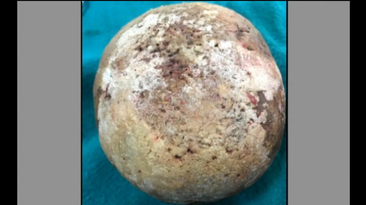 Doctors Remove A Big Stone Weighing 1200 gm From A Patient's Urinary Bladder