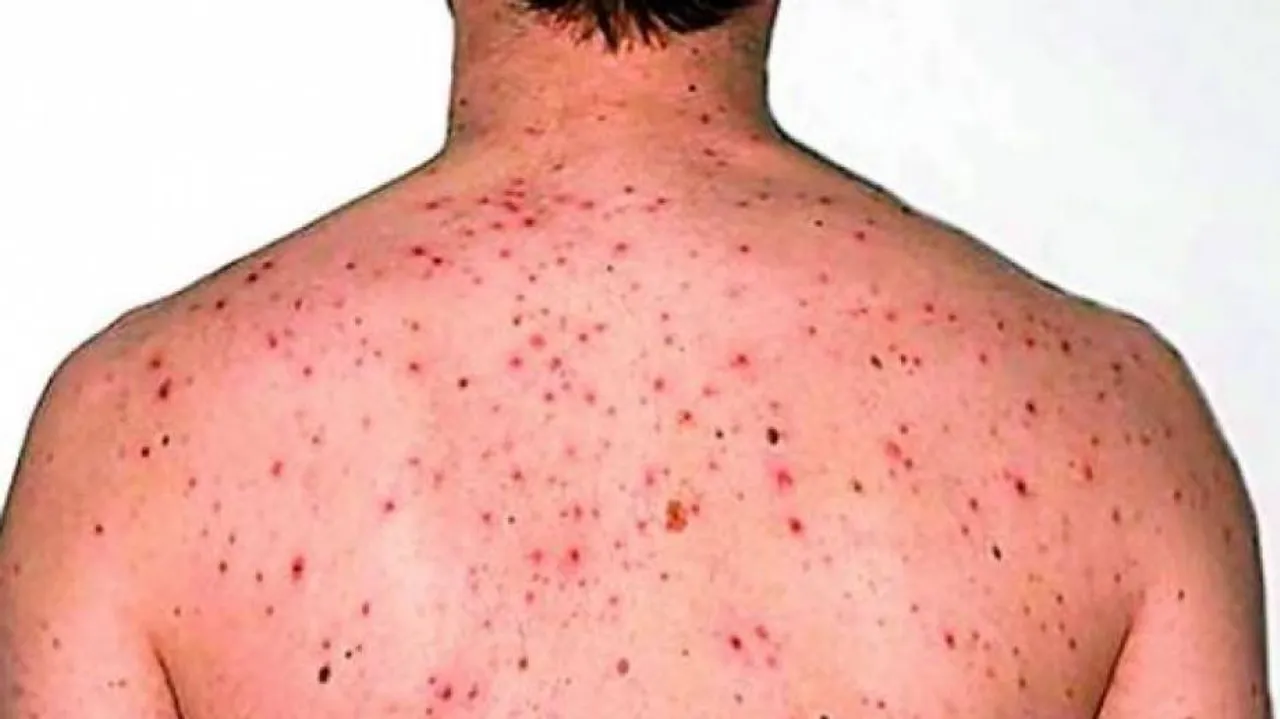 ଆମେରିକାକୁ ୨୦ ବର୍ଷ ପରେ ଫେରିଲା ବିରଳ ଭାଇରସ୍ ମଙ୍କି ପକ୍ସ