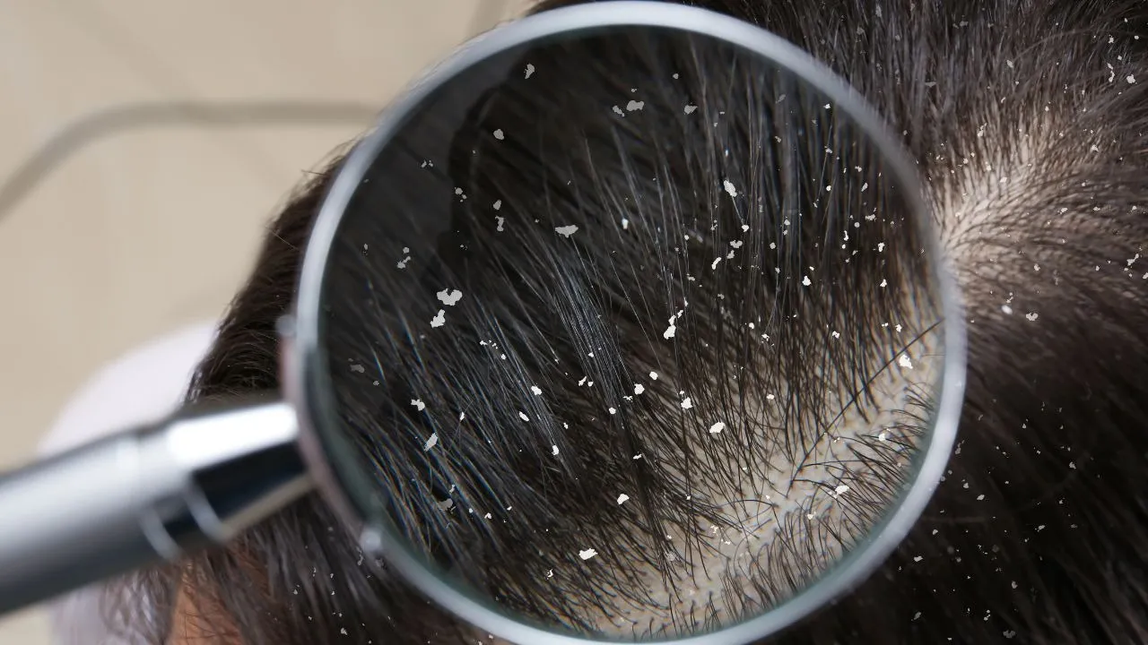 How to prevent dandruff during winter