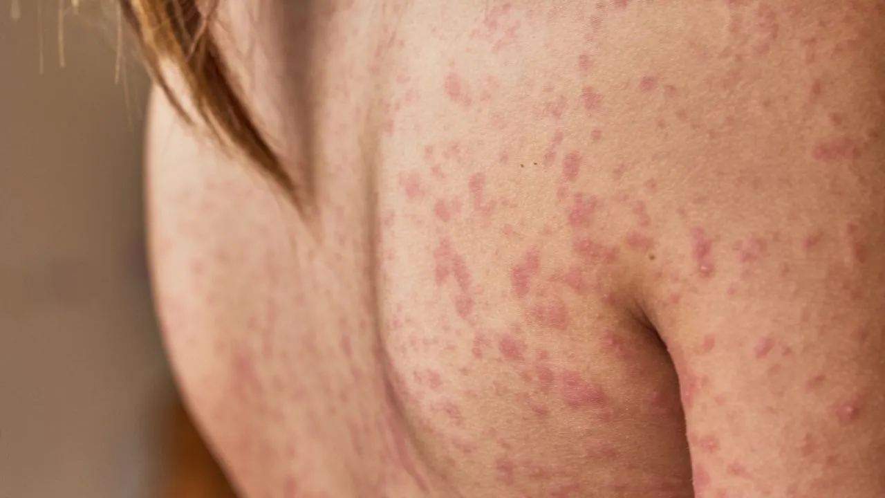 Warning signs on your skin: 7 symptoms that may indicate uncontrolled diabetes