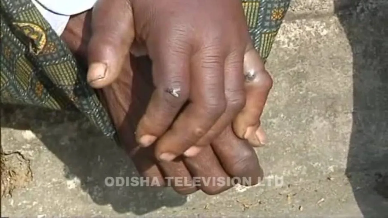 Anthrax scare in Bisra; 2 dead, 9 admitted to hospitals