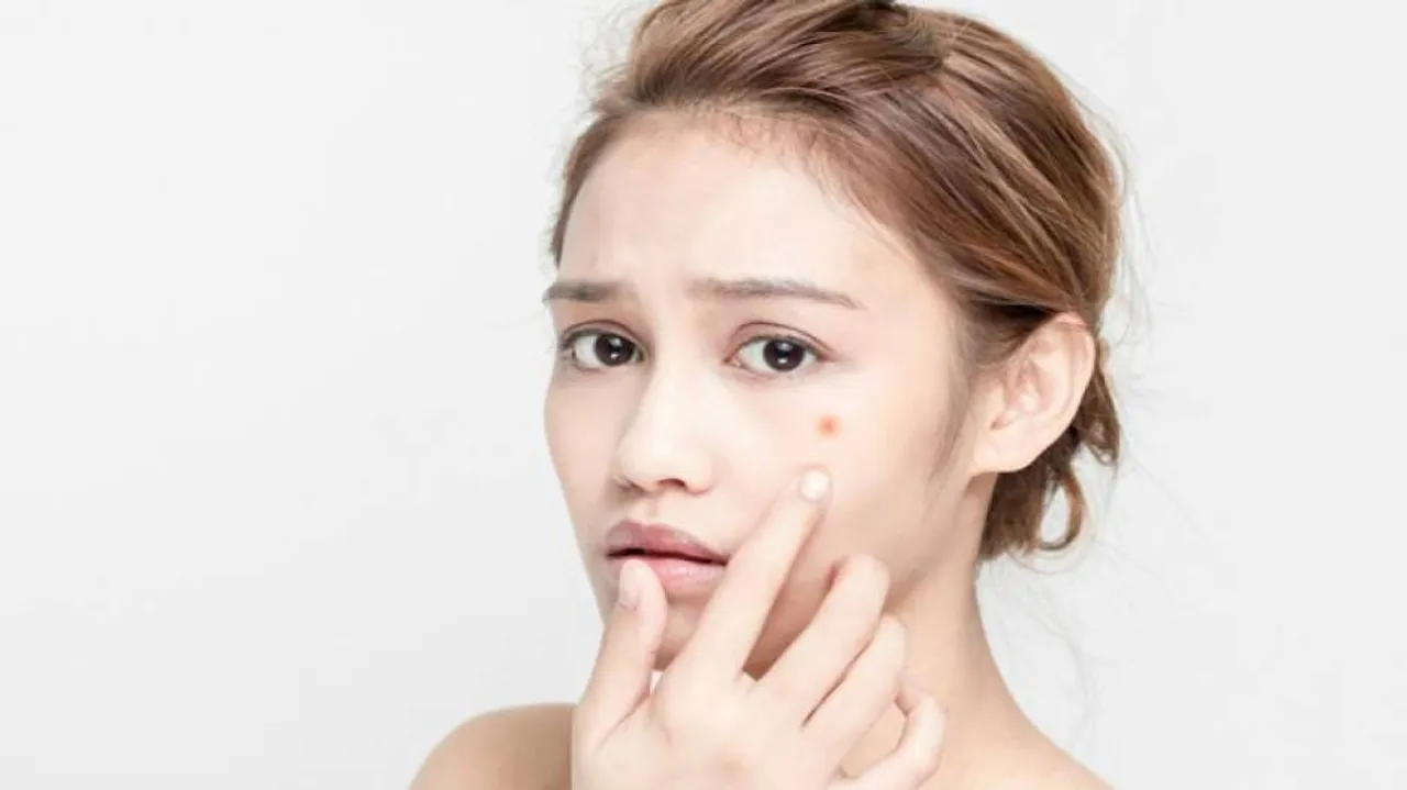 Probiotics An Effective Alternative To Treat Acne
