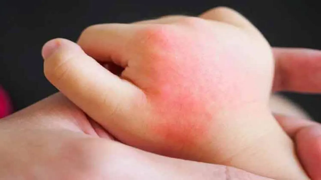 Heavier Babies More Likely To Develop Childhood Allergies