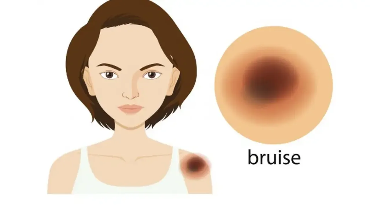 bruises on your skin