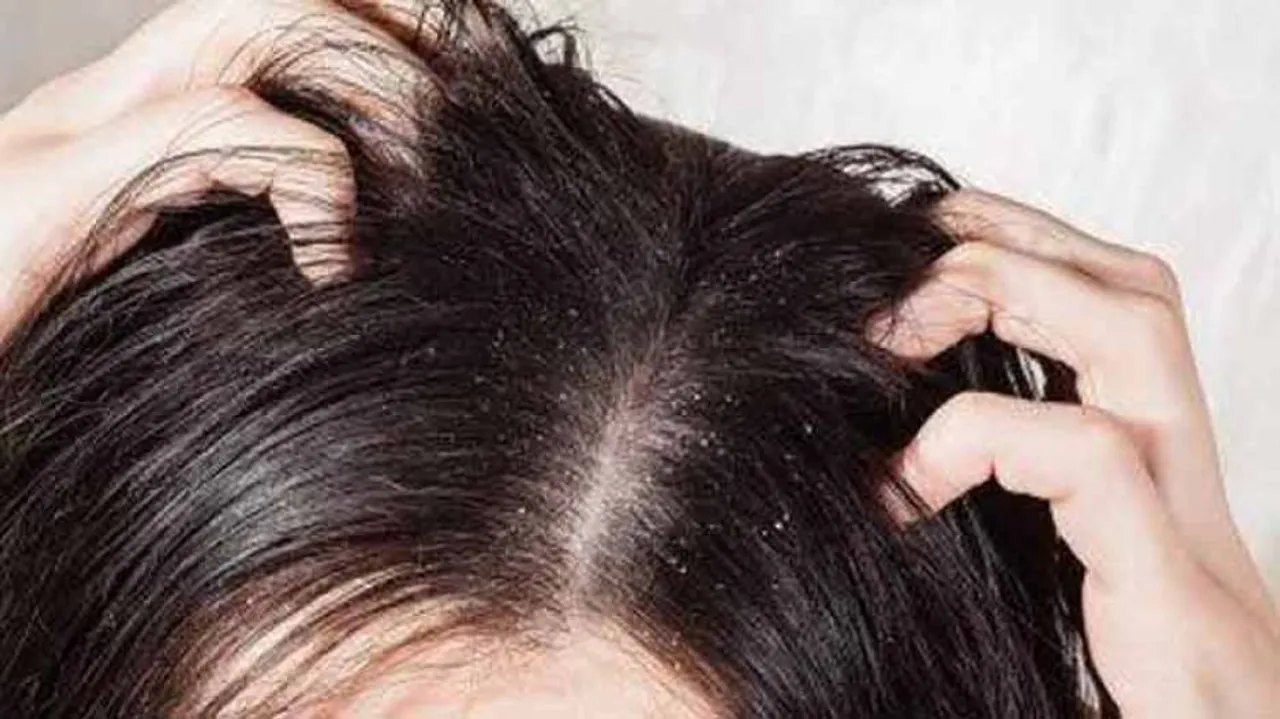 Top 3 Remedies To Treat Dandruff In Winter