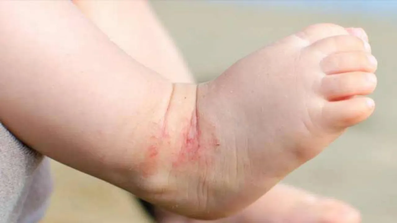 Using Daily Moisturisers Cannot Prevent Eczema In Babies