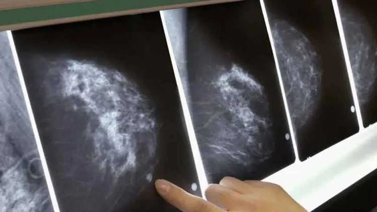 Google AI Model Beats Humans In Detecting Breast Cancer