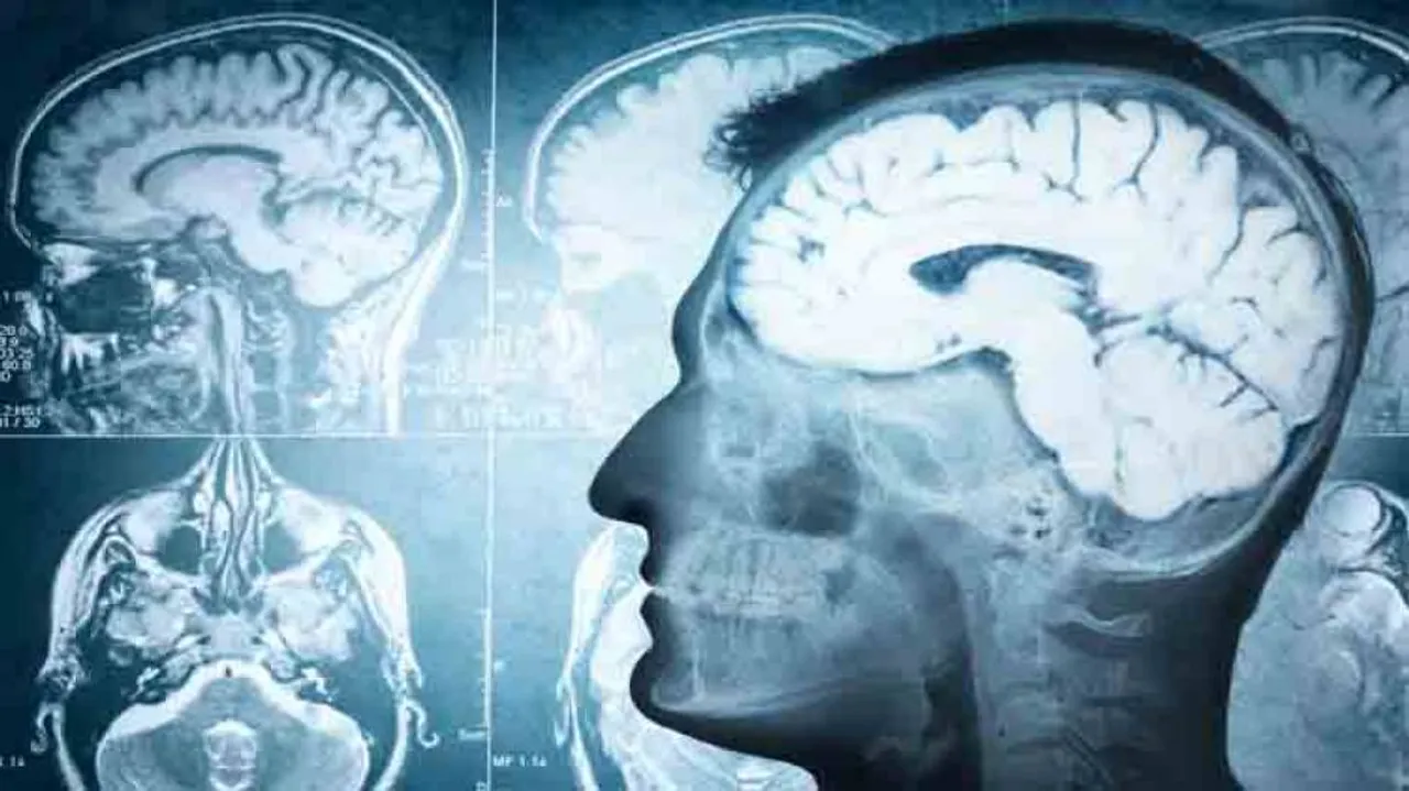 Possible cause for Alzheimer's, traumatic brain injury identified