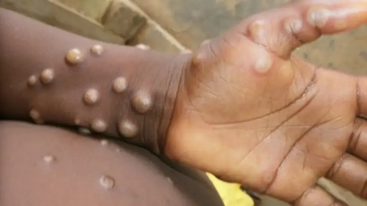Monkeypox cases 
