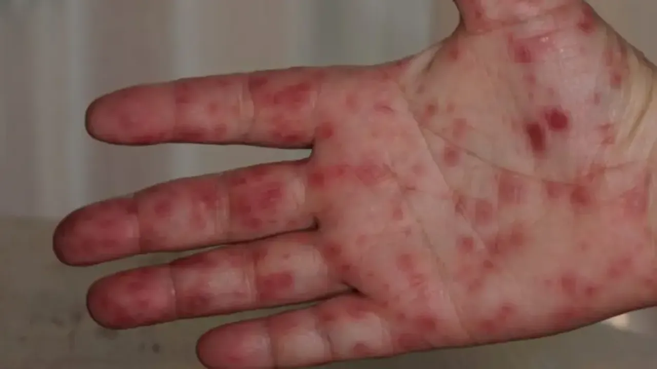 Tomato Flu in Odisha