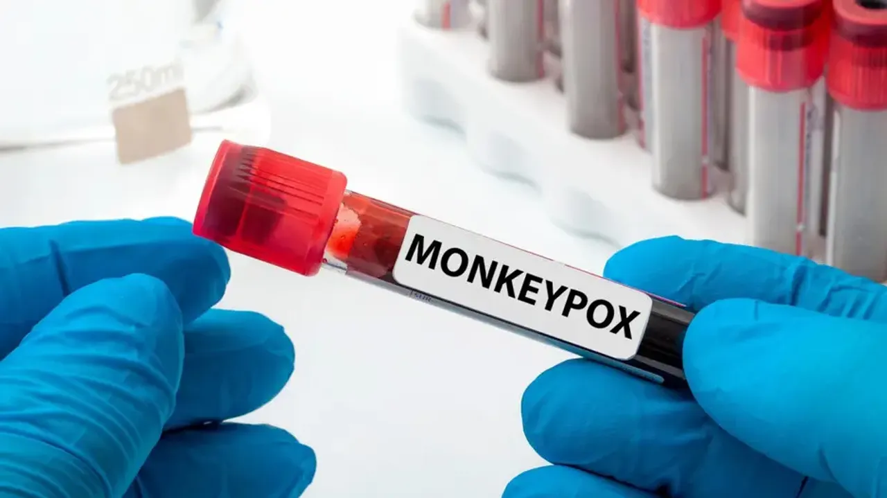 Peru faces 'community transmission' of monkeypox: Top health official