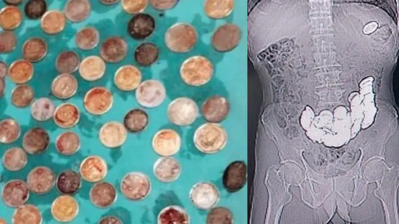 Patient swallows 187 coins due to rare mental disorder, doctors removed them through surgery