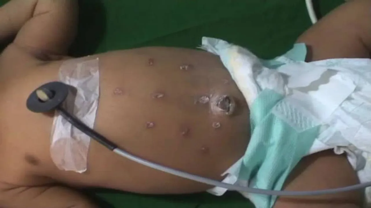 8-day-old branded with hot iron ring by family