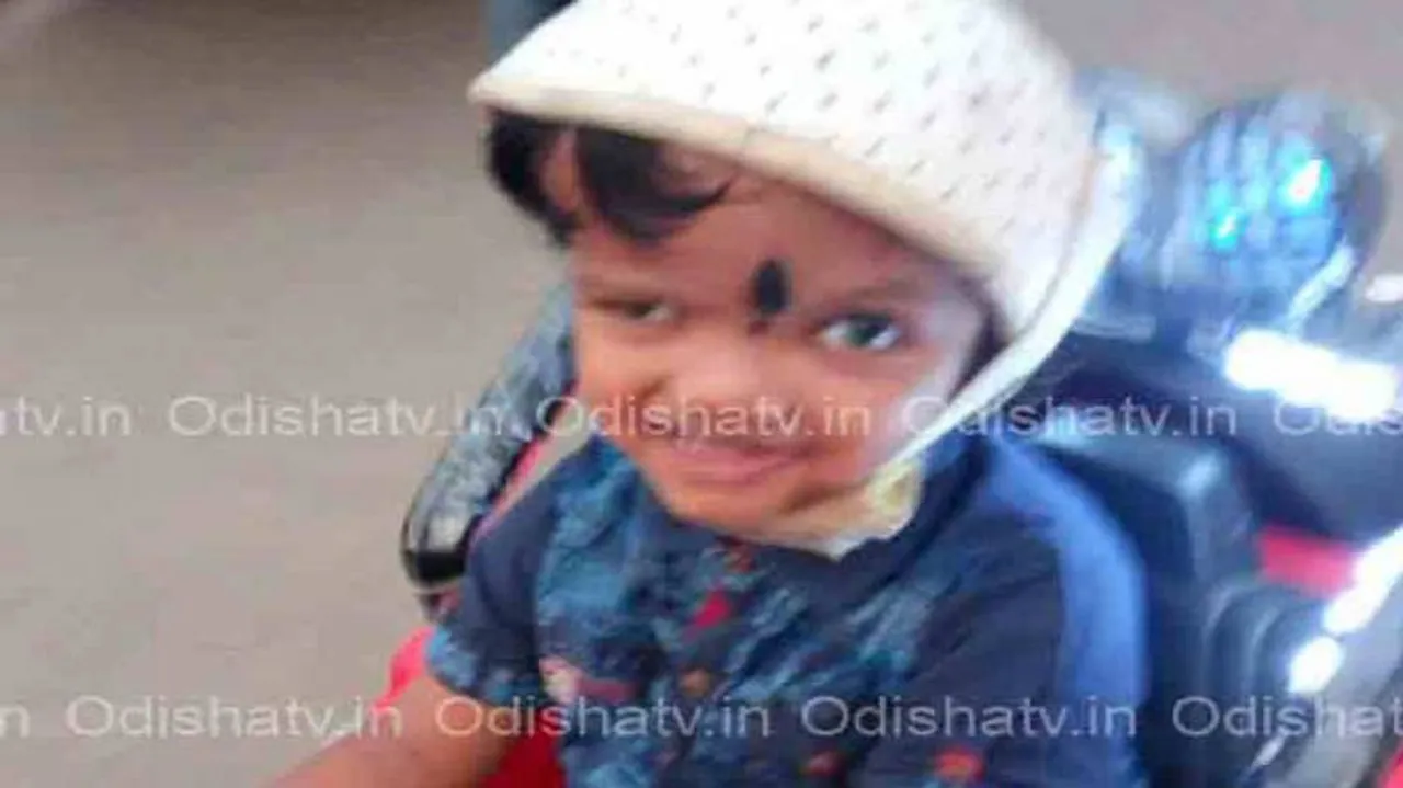 Separation of Conjoined Twins: One year on, Jaga’s improvement beyond expectation