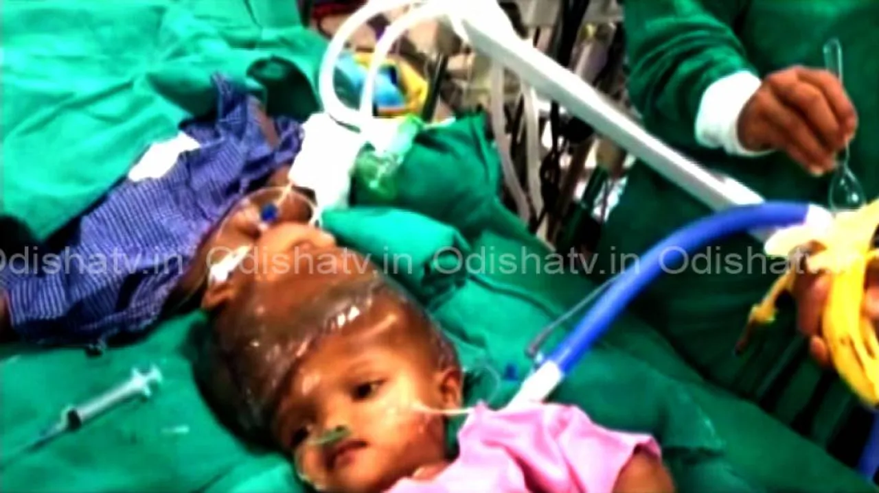 Conjoined twins Jaga-Kalia separated
