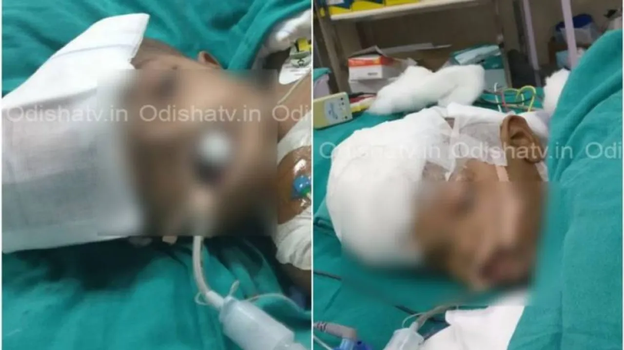 Condition of separated conjoined twins Jaga & Kalia improving