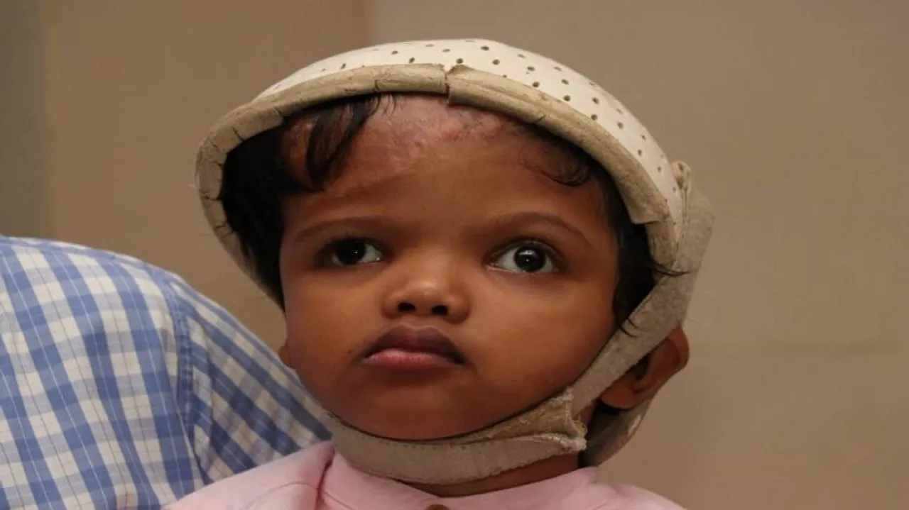 Odisha: Separated Craniopagus Twin ‘Jaga’ To Return To Home District