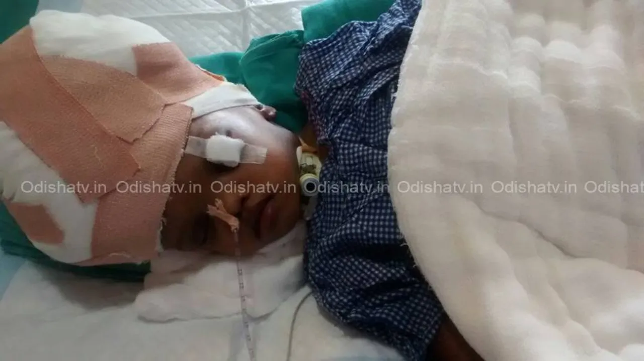 Separation of conjoined twins: Fragile Kalia taken off ventilator