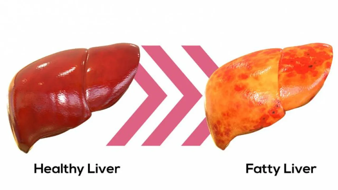 Strength training may reduce fatty liver disease