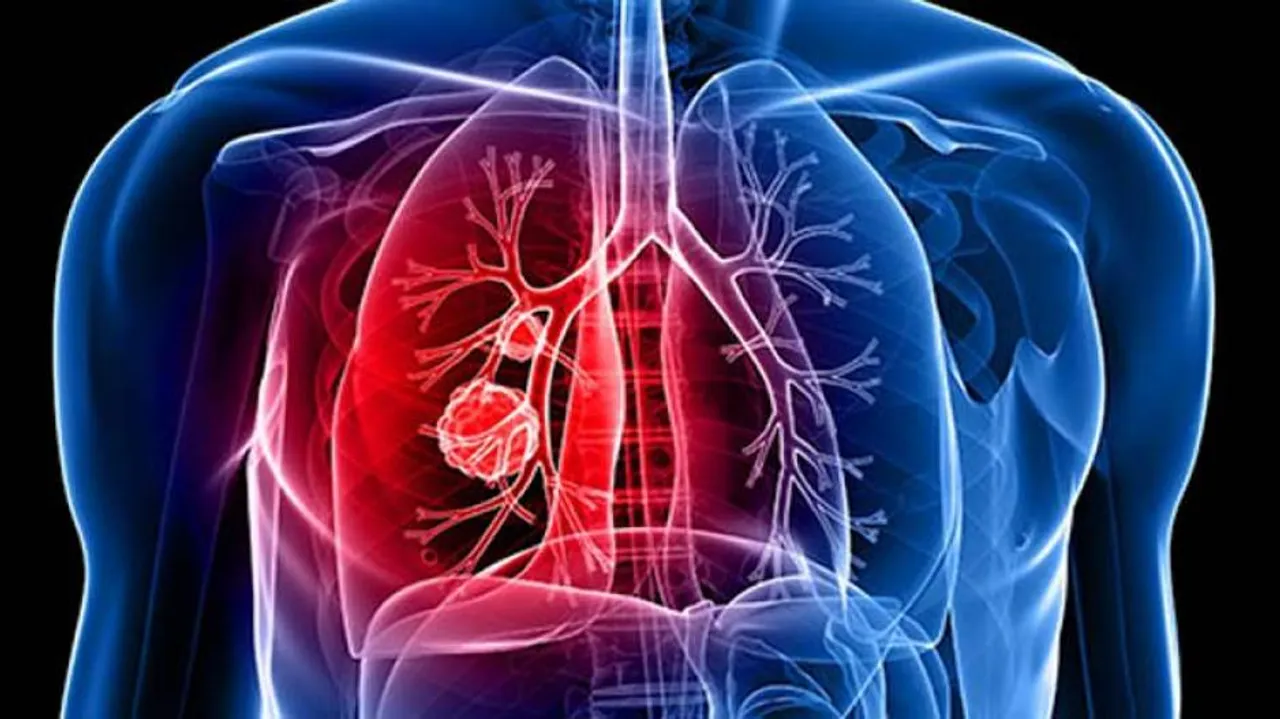 Shortness Of Breath, Cough May Be Early Signs Of Lung Cancer