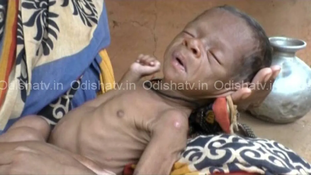 Malnutrition continues to haunt Nagada